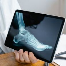 Standing X-ray of Both Feet – AP and Lateral Views