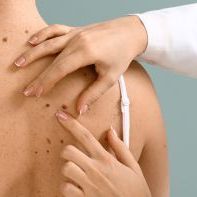 Skin marks under control – video dermatoscopy