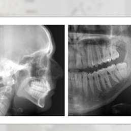 Rtg pantomograficzne + cefalometryczne
