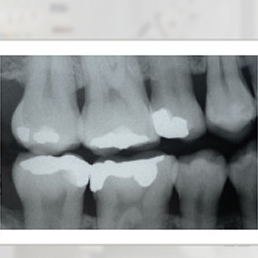 Bitewing tooth X-ray
