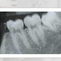 X-ray of teeth