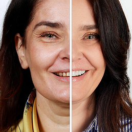 Smile etamorphosis - consultation